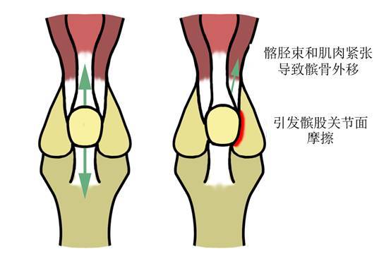 利用步行減輕關(guān)節(jié)壓力