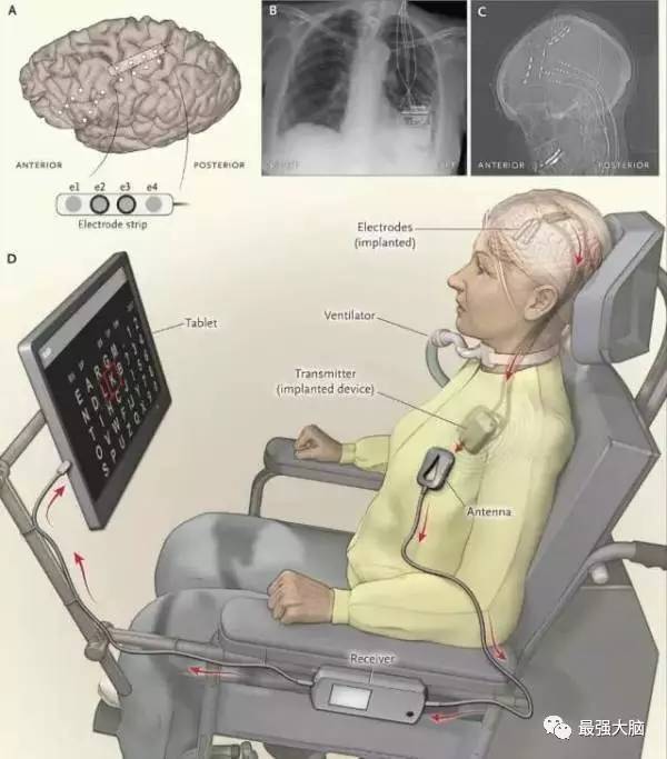 腦機接口如何幫助重度殘疾患者恢復(fù)運動能力