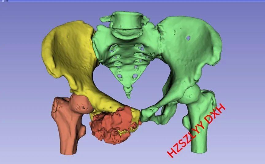 3D打印技術助力醫(yī)療領域定制化需求的改善